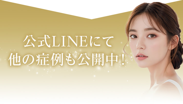 公式LINEにて他の症例も公開中！