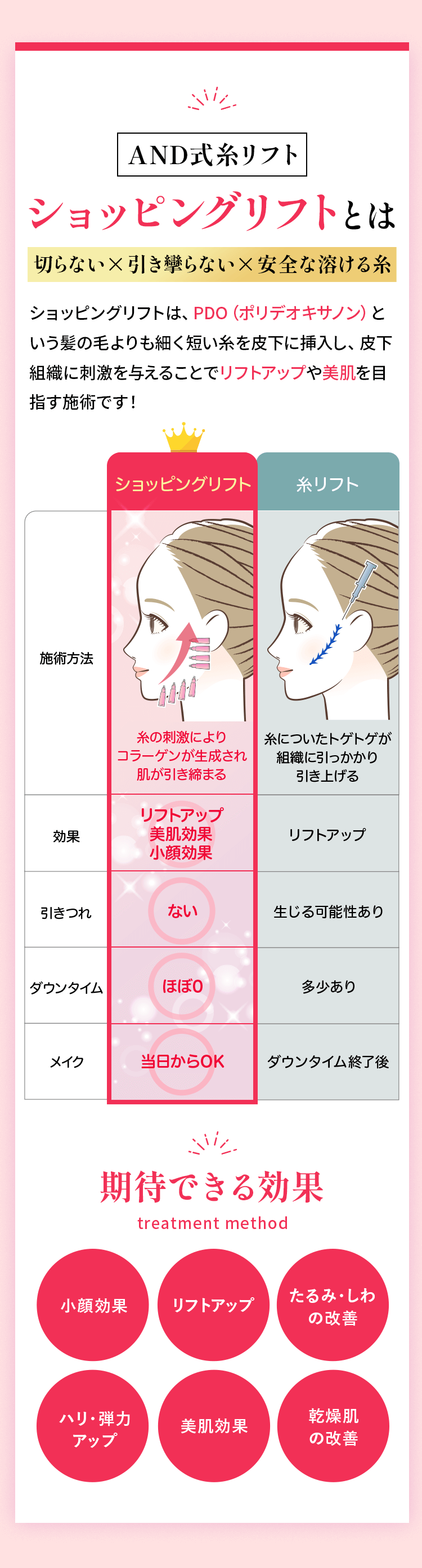 AND式糸リフト ショッピングリフトとは