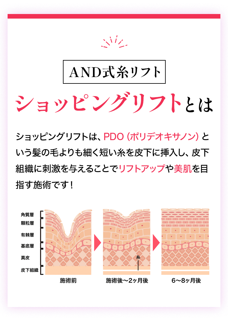AND式糸リフトショッピングリフトとは