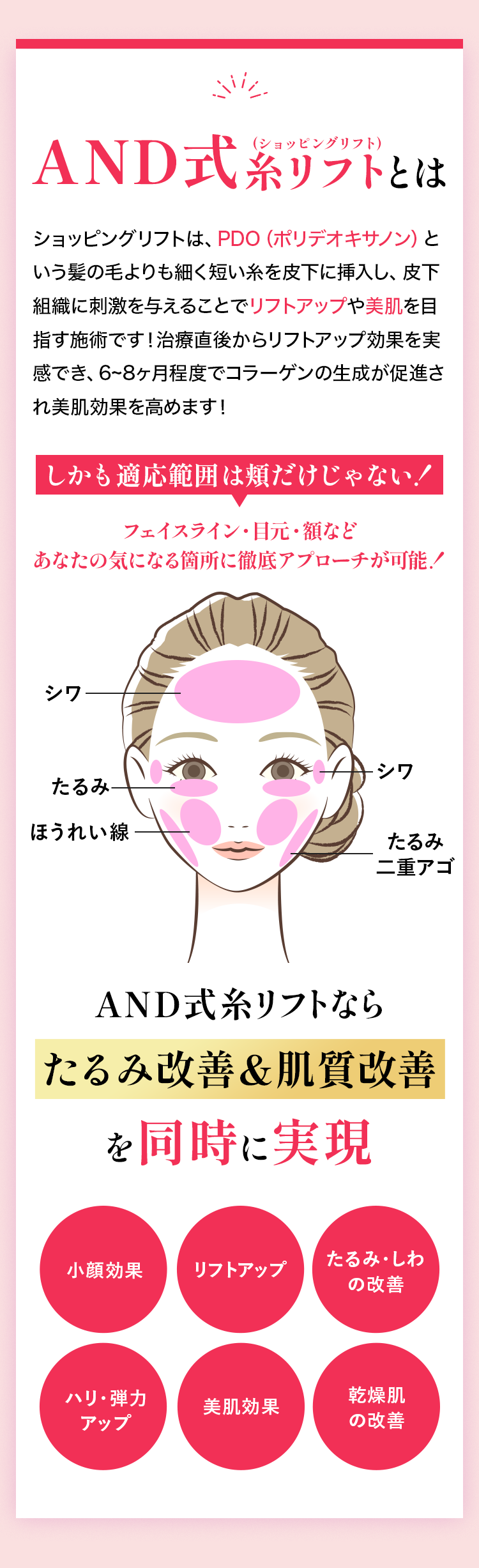 AND式糸リフトショッピングリフトとは