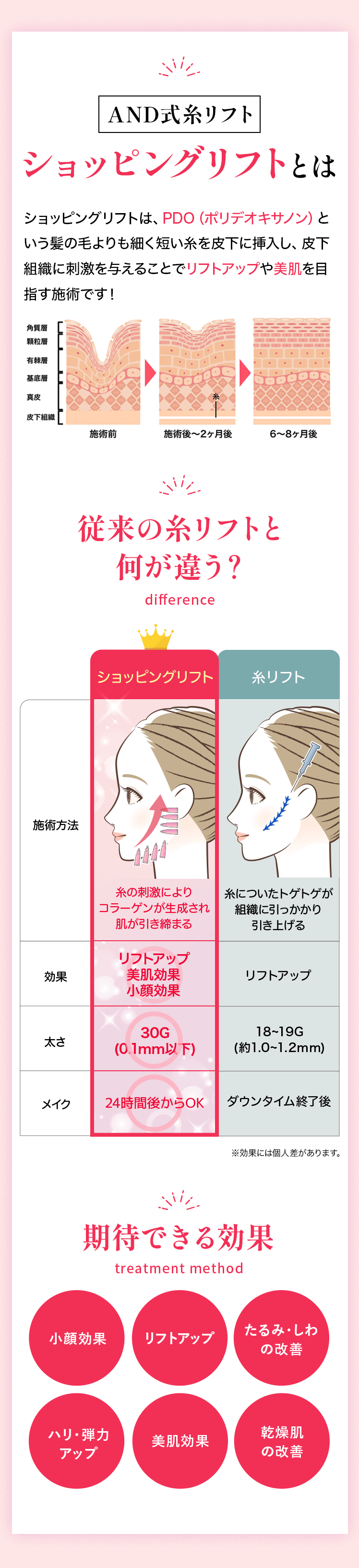 AND式糸リフトショッピングリフトとは