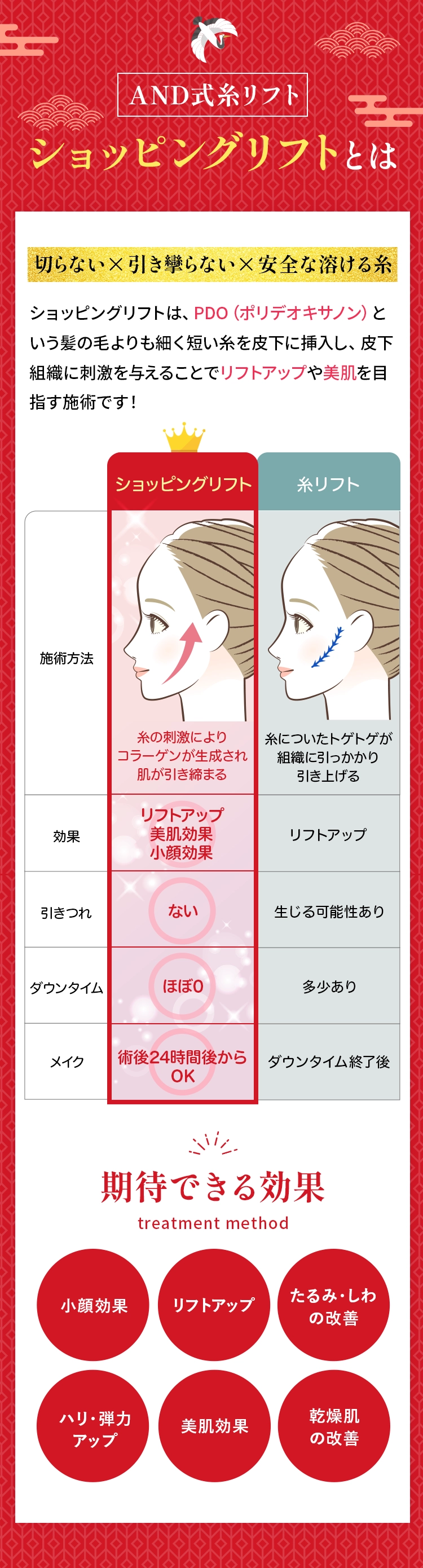 AND式糸リフト ショッピングリフトとは